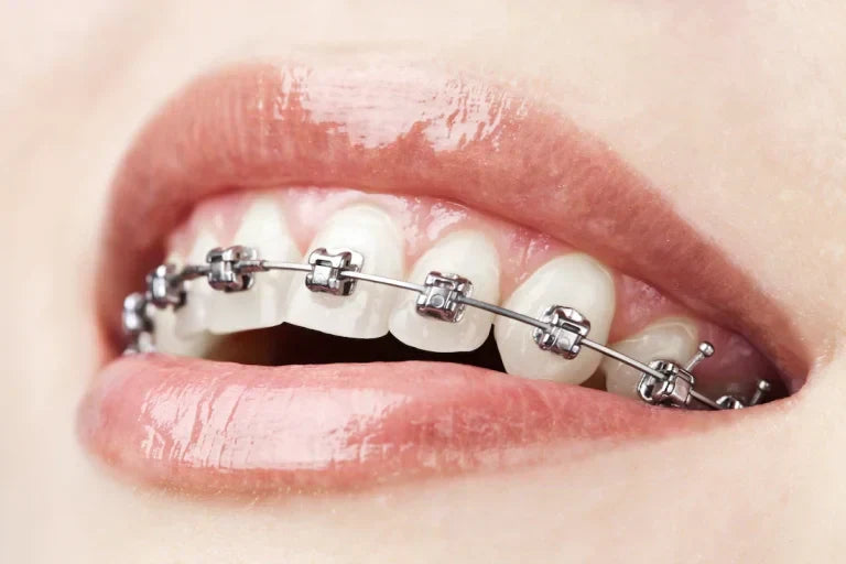 Choosing Mini Implants in Orthodontics A Complete Guide